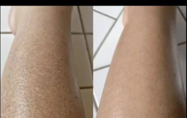 ✴️ كيفية إزالة جلد الوزة بطرق طبيعية وجعل الجلد ناعمًا ولامعًا دائمًا