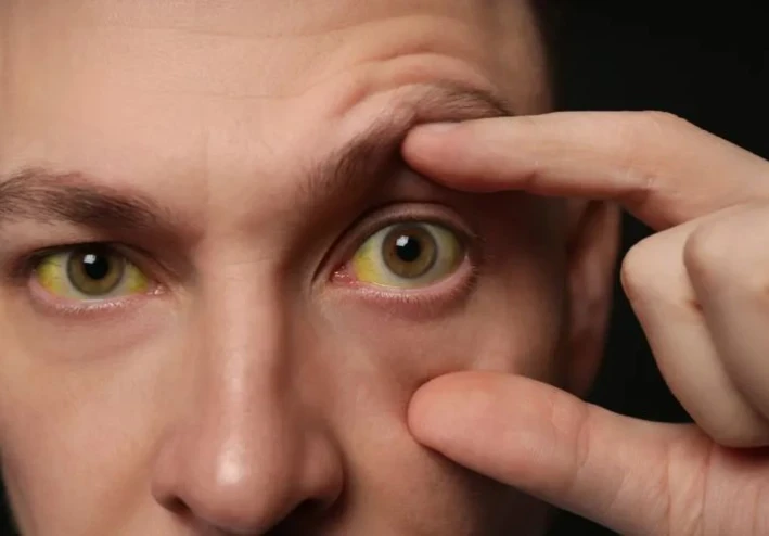 الصفراء ( Jaundice): أسبابها وطرق علاجها الصحيحة