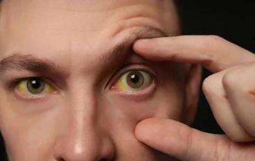 الصفراء ( Jaundice): أسبابها وطرق علاجها الصحيحة