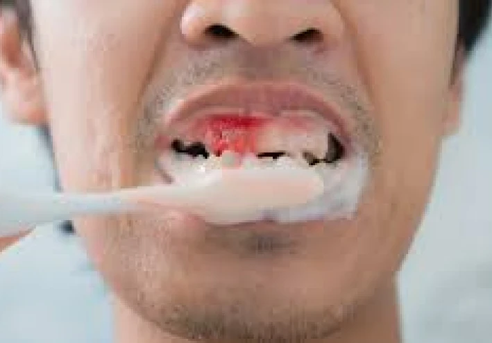 "إذا لم ننظف هناك ، فسيحدث التهاب اللثة"