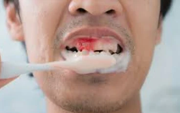  "إذا لم ننظف هناك ، فسيحدث التهاب اللثة"