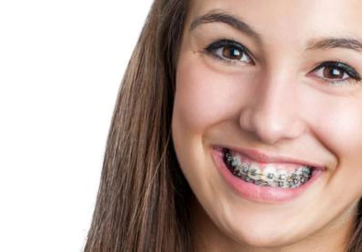 صعود تقويم الأسنان في 50: يبدو وكأنه تافه ولكنه يمنع المشاكل الصحية