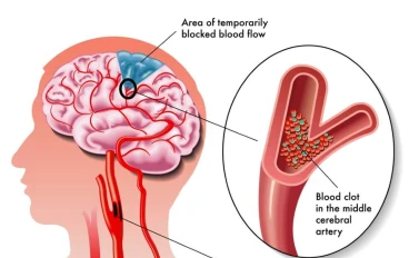   ستة معايير تتنبأ بخطر الإصابة بالسكتة الدماغية أو النوبة القلبية