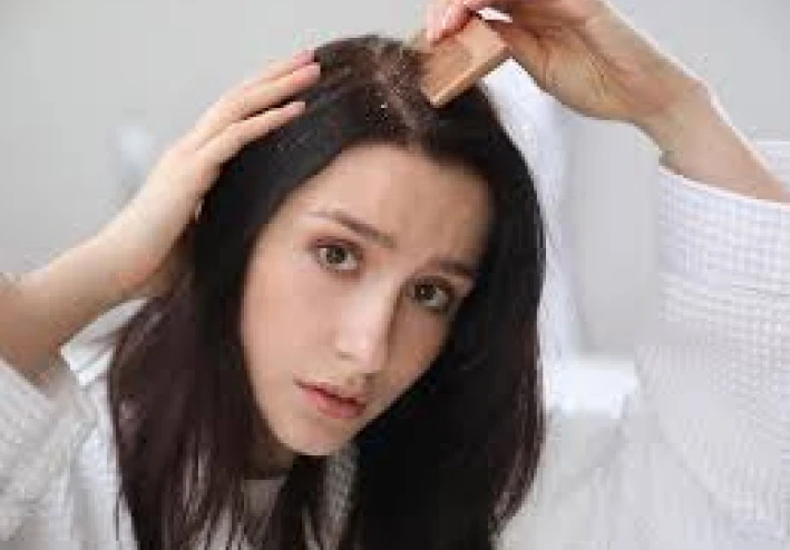 قشرة الرأس في الشتاء ، دراما الشعر الصغيرة التي تصل دون سابق إنذار عندما تنخفض درجات الحرارة