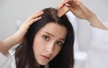 قشرة الرأس في الشتاء ، دراما الشعر الصغيرة التي تصل دون سابق إنذار عندما تنخفض درجات الحرارة