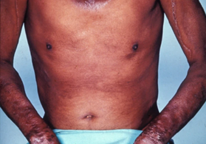 اغرب تجربة طبية فى العالم  للتخلص من الموت الاحمر