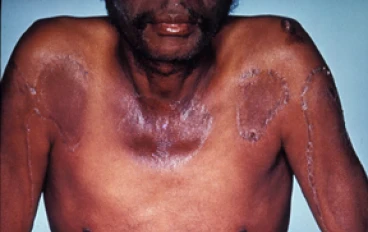 اغرب تجربة طبية فى العالم  للتخلص من الموت الاحمر