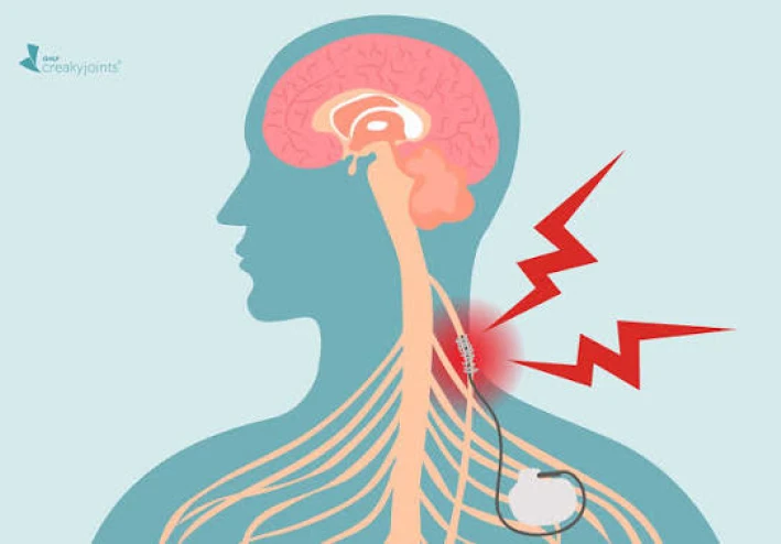 كيف تقى نفسك من التهاب العصب الحائر