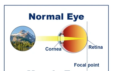 عبوب الابصار وأشهر طرق علاجها 