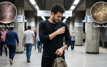     التخلص من القشرة نهائيًا: دليلك الشامل للتخلص من قشرة الرأس دون عودة