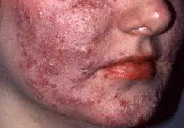 الجروح والتهيج والبقع وظهور حب الشباب والالتهابات على الوجه... قصص الرعب وراء الانزلاق الجلدي