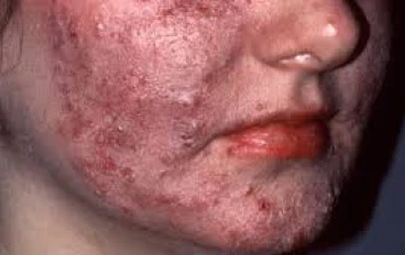 الجروح والتهيج والبقع وظهور حب الشباب والالتهابات على الوجه... قصص الرعب وراء الانزلاق الجلدي