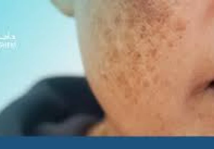 الكلف والتصبغات العنيدة: لماذا يُعتبر الترانيكساميك نقلة نوعية؟