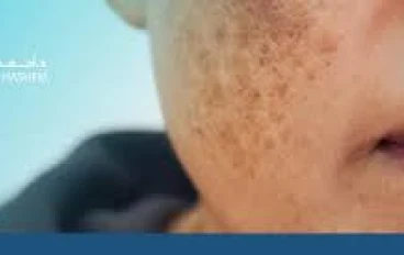 الكلف والتصبغات العنيدة: لماذا يُعتبر الترانيكساميك نقلة نوعية؟