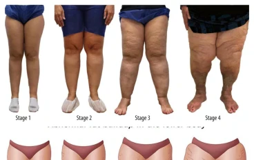 "الليبيديما مرض العصر الصامت: معاناة خفية خلف زيادة الوزن لا يفهمها الكثيرون"