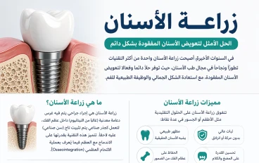  زراعة الأسنان: الحل الحديث لاستعادة الابتسامة