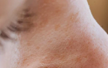 علاج المسام الواسعه: 5 طرق للحصول على بشره ناعمه وصافيه